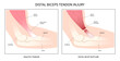 distal bicep tendonitis rotator cuff pain upper arm inflamed