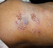 © ZAY WIN HTAI - Herpes simplex infection at lower back. Small and painful vesicles.