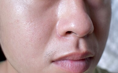 Fair skin with wide pores in oily face of Asian, Myanmar or Korean adult young man.