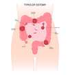 Small and Large Colon blocked Surgery abdomen Pouch with Crohn Hirschsprung disease inflammation of hernia stoma by removal Rectal tract poo stool system Cancer ileum Tumor Loop invasive