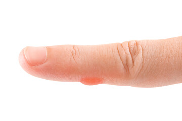 blister on finger skin, human body damage callus, health care theme, injury worker forefinger with dry skin close-up isolated on white background.