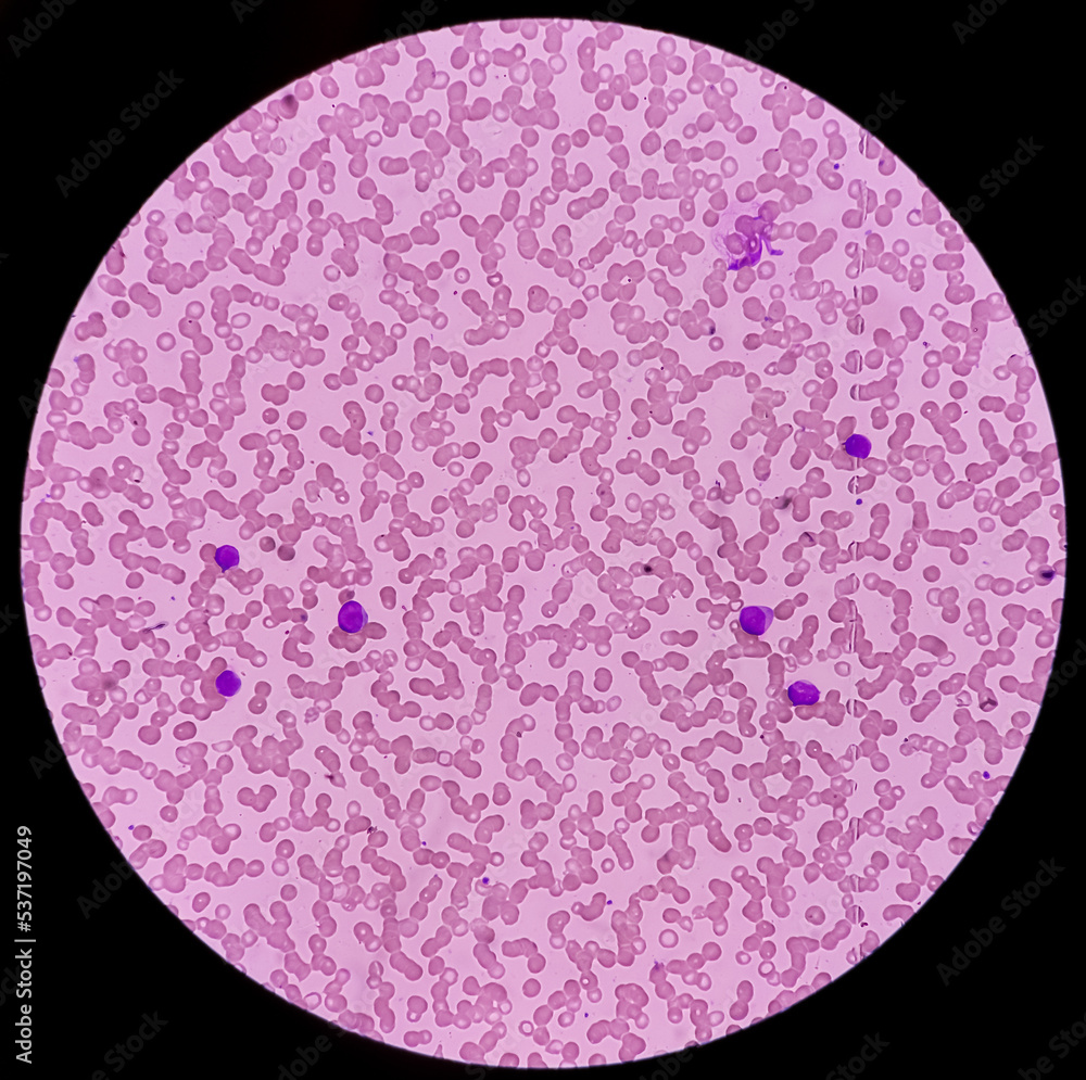Acute myeloid leukemia (AML). AML is the most common leukemia.