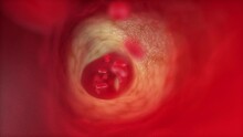 3d rendered medical animation of  a blocked artery