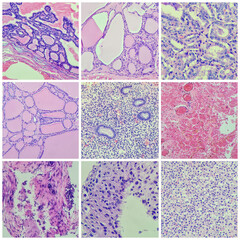 Wall Mural - Camera photo of various pathological slides from thyroid gland,  endometrium and breast, magnification 400x, photograph through a microscope