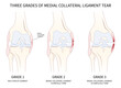 classification of Medial collateral ligament Injury test athletic meniscal femur pop hurt grade
