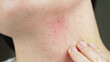 © julia_diak - A close-up hand touches a red inflamed acne. Allergic reaction, dermatitis. Cosmetology.