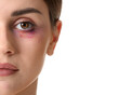 © Pixel-Shot - Young woman with bruise under eye on white background, closeup