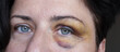 Close up of bruised woman eye. Face of a woman with a hematoma