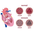 Stenosis of the aortic valve of the heart. Disease infographic. Vector illustration