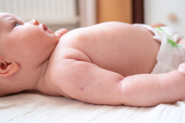 A mark on the baby's arm from BCG vaccination