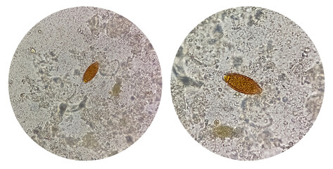 Poster - Photo collage of Trichuris trichiura ova (whipworm) in stool, analyze by microscope. Parasite egg.