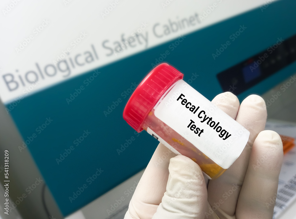 Laboratory technologist holding sample container with feces or stool ...