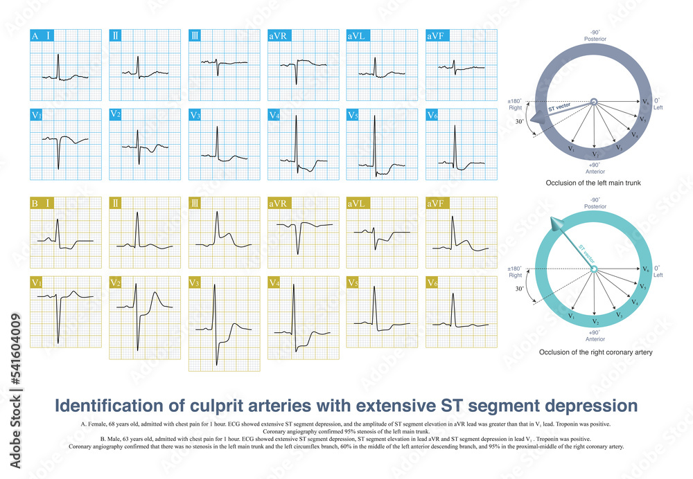 Ilustración de Stock When extensive ST segment depression occurs, the ...