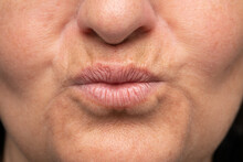 Aged Lip Problem In A Lady's Mouth