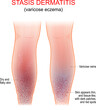 Varicose eczema. Symptoms of venous, gravitational or stasis dermatitis