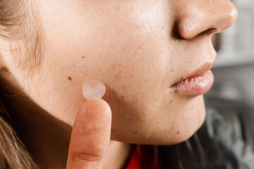 girl with acne stick round acne patch on her cheek. woman using acne patches for treatment of pimple