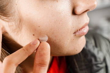 girl with acne stick round acne patch on her cheek. woman using acne patches for treatment of pimple