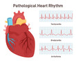 Pathological heart rhythm types. Heart rate graphic or electrocardiogram.