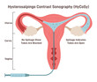 Hysterosalpingo contrast sonography. Comprehensive examination of female