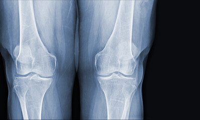 Film x-ray of human knee normal joints and ligaments Medical image concept.