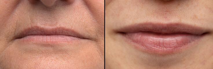 Comparison between old and young lips