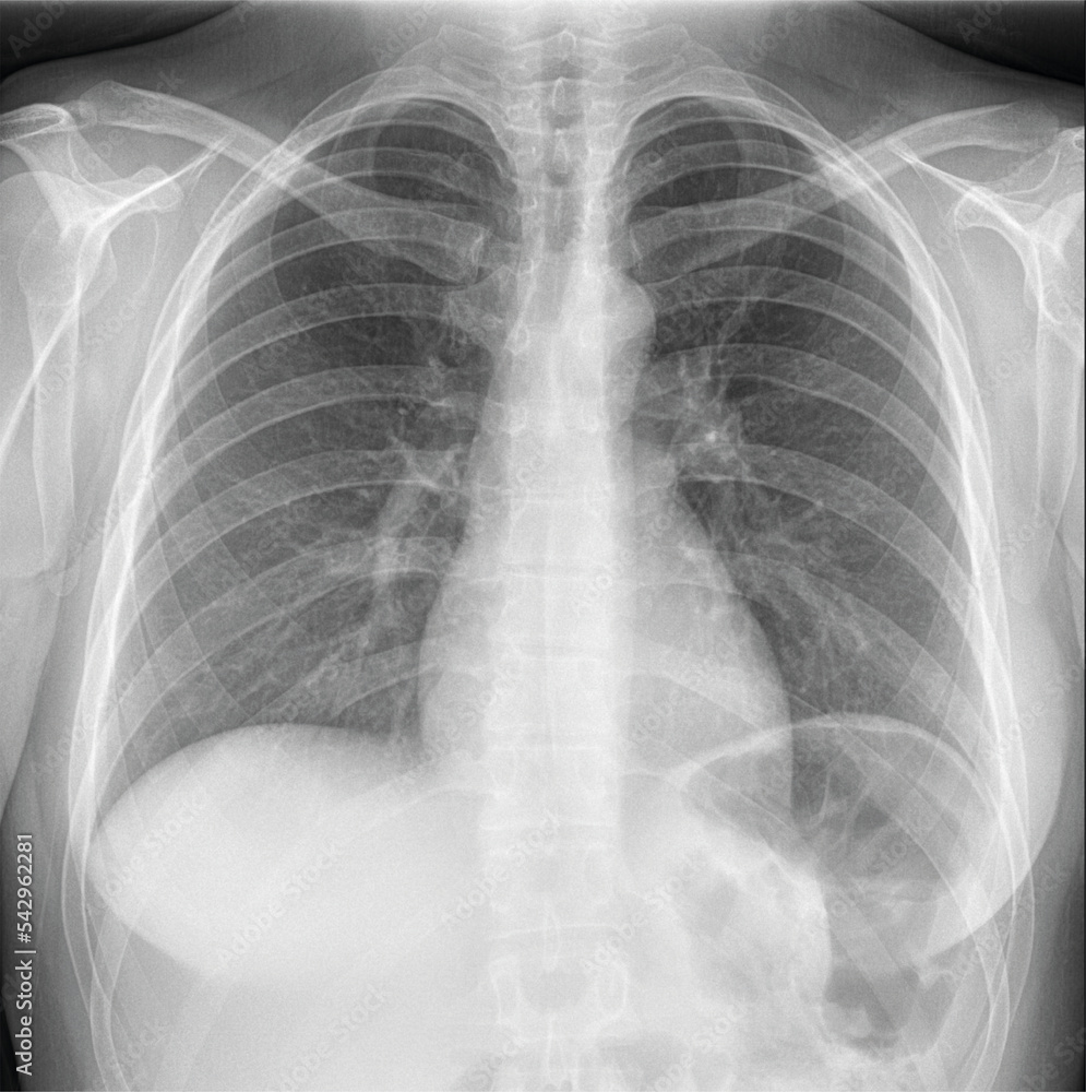 Patient Chest Chest X-ray. Frontal view of a patient chest. Stock Photo | Adobe Stock