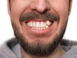 The guy has crooked teeth with a canine