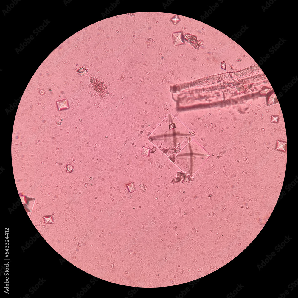 Urine sediment showing Struvite and Calcium oxalate dihydrate crystals ...