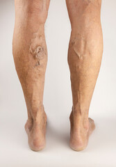 Varicose veins on men's legs. Treatment of varicose veins.