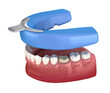 Dental impression. Treatment Planning. Medically accurate tooth 3D illustration