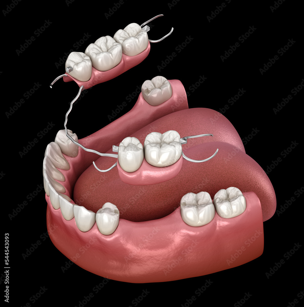 Removable partial denture, mandibular prosthesis. Medically accurate 3D ...