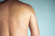 Close-up of red inflamed flaky itchy skin of bare back with blemishes of unrecognizable man suffering from psoriasis.