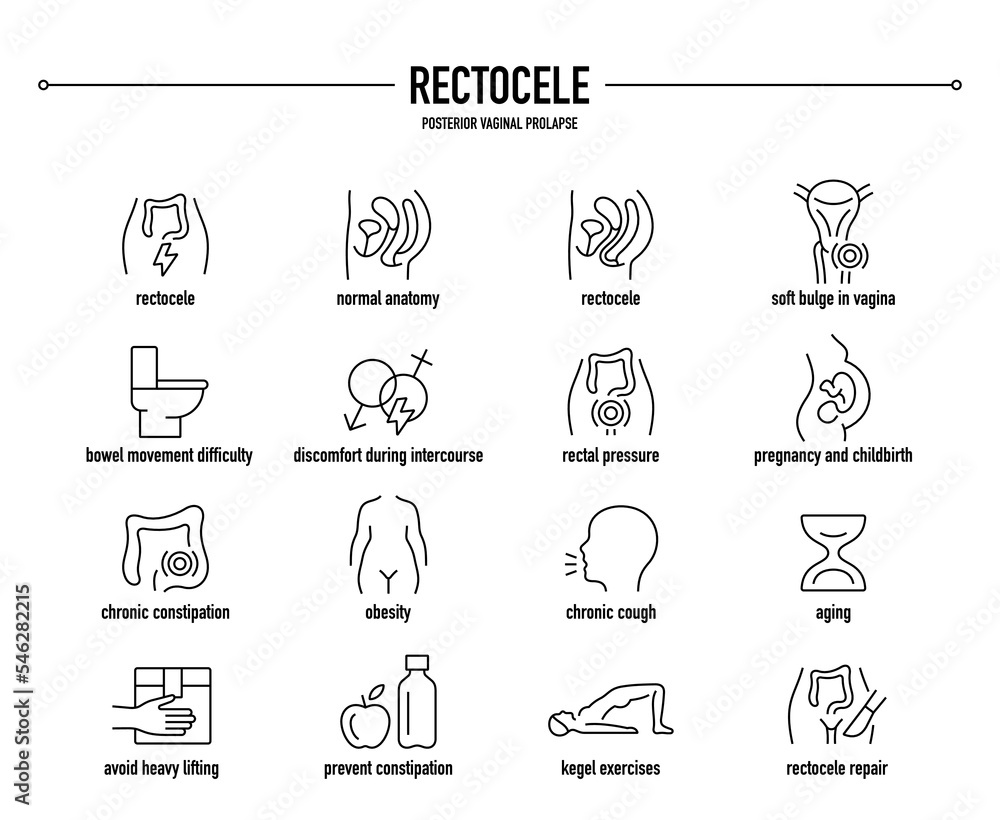 Rectocele, Posterior Vaginal Prolapse symptoms, diagnostic and ...
