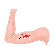 open laceration on arm. Traumas of skin on body part. Vector illustration of open cut wounds with bleeding, fracture and bruise