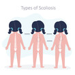 Educational poster with different types of scoliosis. Child with disorders of musculoskeletal system. Example of scoliosis of varying degrees. Spinal curvature concept. Back view.