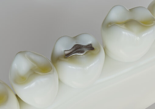 Amalgam restorationn in a tooth - 3D Rendering
