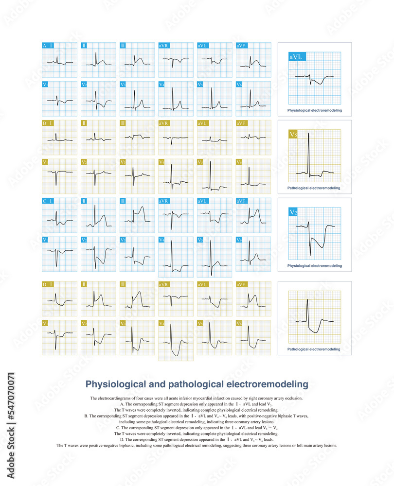 St Inversion Example In acute inferior myocardial infarction, physiologically corresponding ...