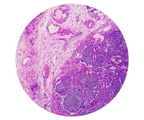 Canvas Print - Microscopic view of Trichomonas vaginalis in pap smear with few acute inflammatory cells. Cytology and pathology laboratory department. Sexually transmitted disease. Trichomoniasis