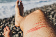 A jellyfish sting burn on a man's leg