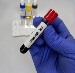 Canvas Print - Blood sample for Serum Urate test. Uric acid.