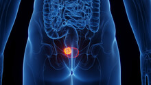 3D Rendered Medical Illustration Of Male Anatomy - Urinary Bladder Cancer.