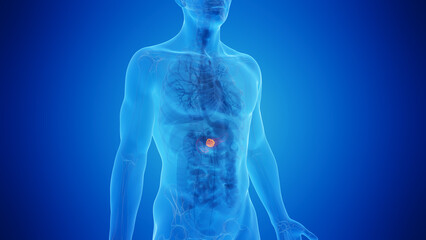 Wall Mural - 3D Rendered Medical Illustration of Male Anatomy - Pancreatic Cancer. Close up. Blue Background