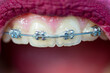 Braces close up. White teeth, dental macro background. Dental care, healthy teeth and smile, white teeth in mouth.