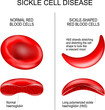 sickle cell disease.