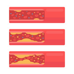 coronary arteries with accumulated fat in the body