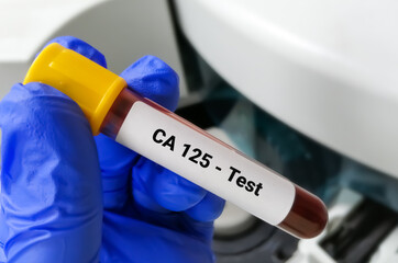 Poster - Blood Sample for CA-125 with laboratory background. Tumor Marker for ovarian cancer.