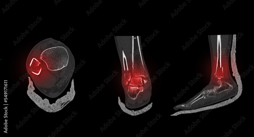 CT Scan ankle and foot or Computed Tomography of Ankle joint and Foot ...
