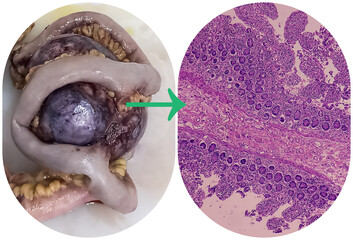 Sticker - Intra abdominal mass with transverse colon(biopsy): Fibromatosis. Nodular mass show spindle cells with bland nuclei, collagen, infiltration of inflammatory cells.