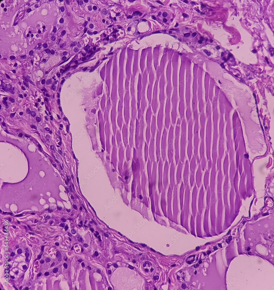 Intra abdominal mass with transverse colon(biopsy): Fibromatosis. Nodular mass show spindle cells with bland nuclei, collagen, elongated vessels and infiltration of inflammatory cells.