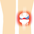 Knee osteoporosis x-ray pain a degenerative joint bone, illustration on white background